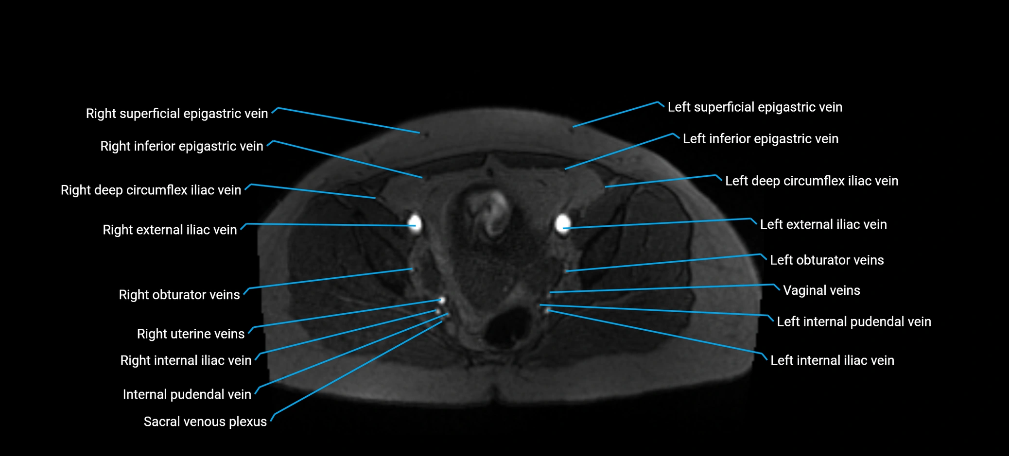 MRV abdomen pelvis & lower limb axial cross sectional anatomy labelled MRI image 163 (1).webp